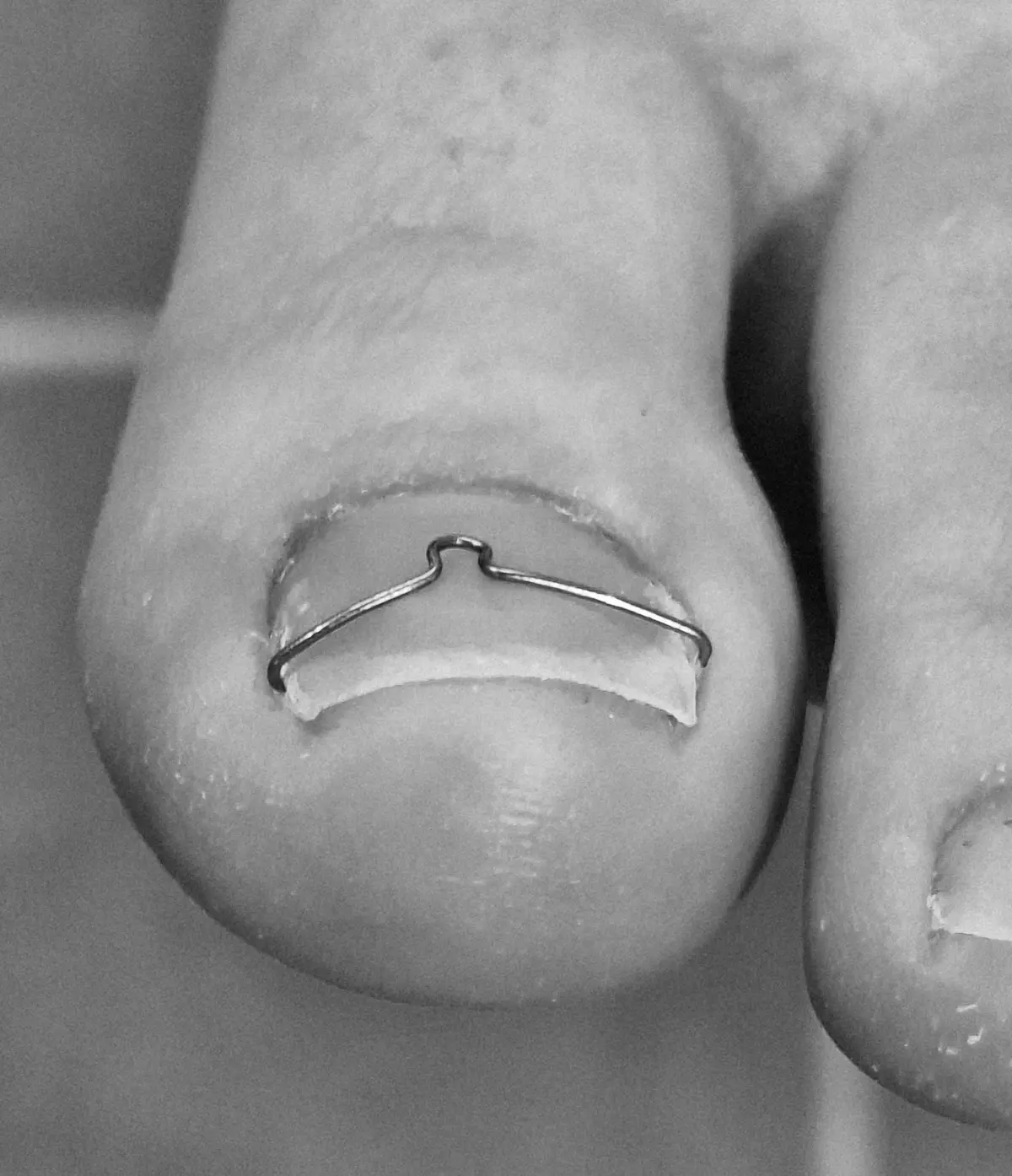 Nagelbeugel